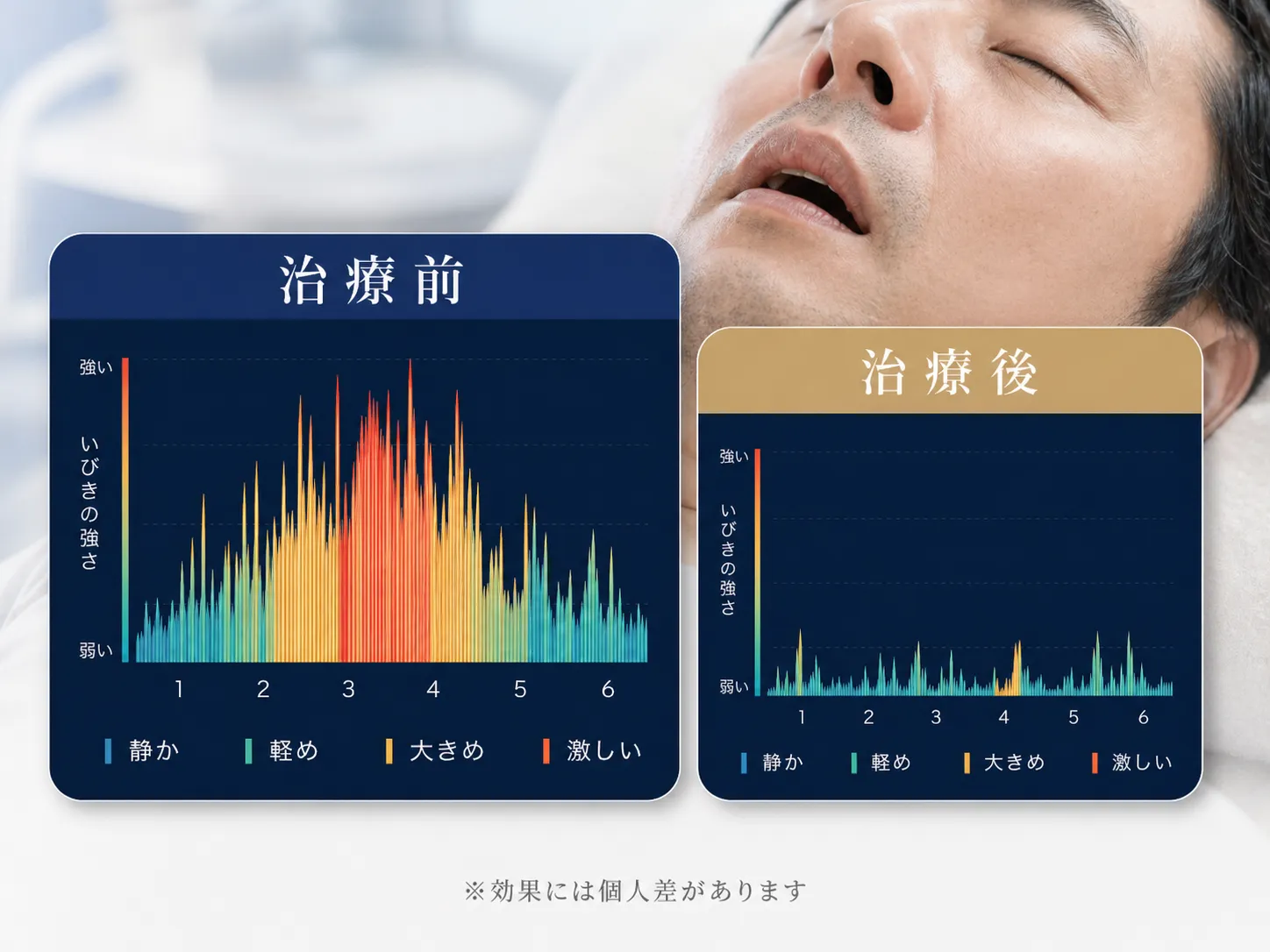 ナイトレーズ 治療前後のいびき強度比較